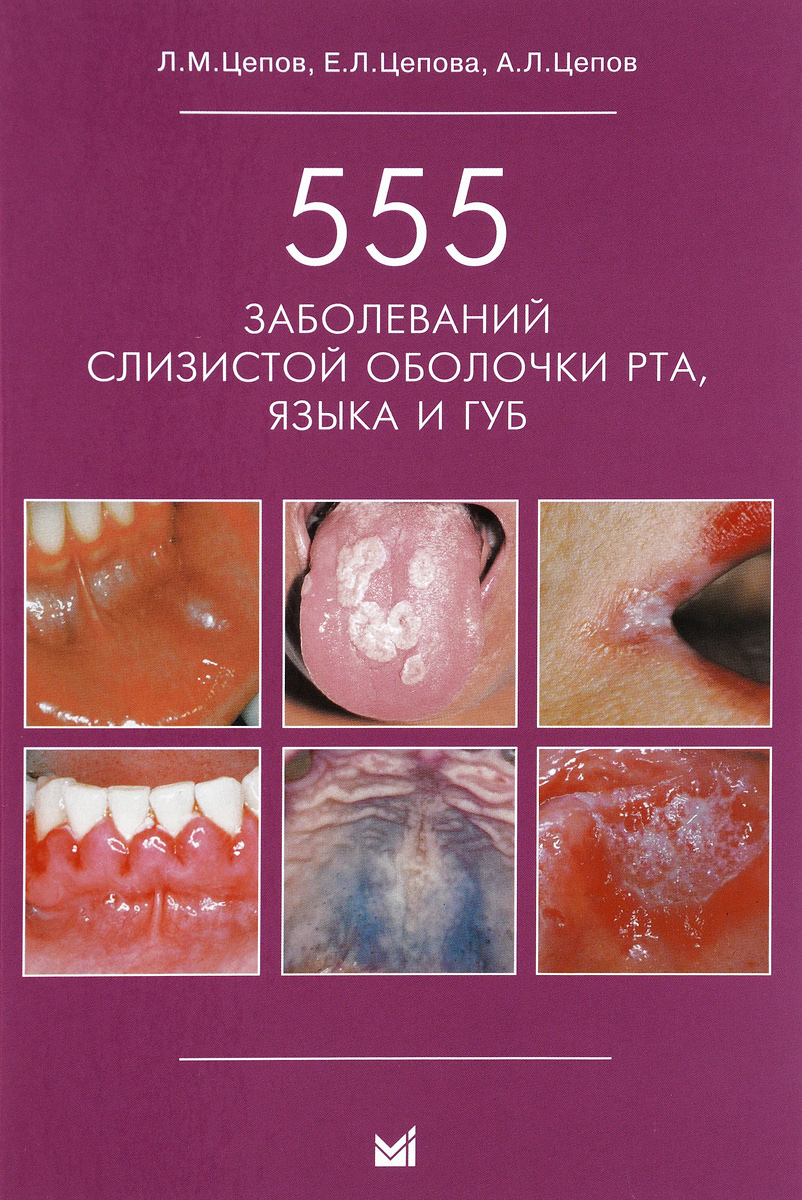 555 заболеваний слизистой оболочки рта, языка и губ изменяется неумолимо приближаясь